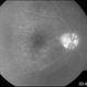 Acute Syphilitic Posterior Placoid Chorioretinitis Acute Syphilitic Posterior Placoid Chorioretinitis