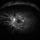 Proliferative Diabetic Retinopathy Proliferative Diabetic Retinopathy