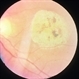 Macular Staphyloma