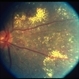 Hypertensive Retinopathy Hypertensive Retinopathy