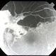 Thick Subretinal Hemorrhage 10 Thick Subretinal Hemorrhage 10