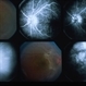 Inflammation Inflammation