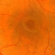 Macular Hole Macular Hole