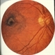Macular Pigments Macular Pigments