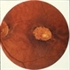 Macular Atrophy Macular Atrophy
