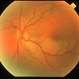 Branch Retinal Artery Occlusion Branch Retinal Artery Occlusion