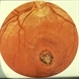 Macular Scar Macular Scar