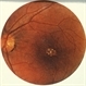 Macular Dystrophy With Drusenoid Changes Macular Dystrophy With Drusenoid Changes