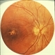 Macular Dystrophy With Drusenoid Changes Macular Dystrophy With Drusenoid Changes