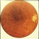 Macular Pigments