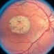 Macular Atrophy Macular Atrophy