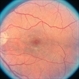 Minimal Macular Pigments Minimal Macular Pigments