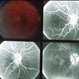 Inflammation Inflammation