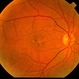 Pattern Dystrophy Pattern Dystrophy