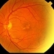 Pattern Dystrophy Pattern Dystrophy