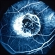 FA Macular Atrophy FA Macular Atrophy