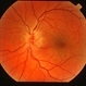 Anterior Ischemic Optic Neuropathy