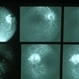 Lyme Disease