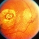 Macular Atrophy Macular Atrophy
