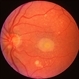 Adult Vitelliform Dystrophy