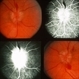 Lyme Disease