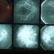 Inflammation Inflammation