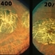 Macular Atrophy Macular Atrophy