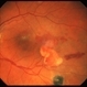 Capillay Hemangioma Von  Hippel