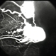 Capillary Hemangioma Capillary Hemangioma
