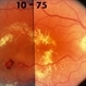 Arterial Macroaneurysm Arterial Macroaneurysm