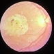 Macular Atrophy Macular Atrophy