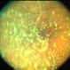 Asteroid Hyalosis Asteroid Hyalosis