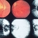 Inflammation Inflammation