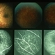 Multiple Evanescent White Dot Syndrome (MEWDS) Multiple Evanescent White Dot Syndrome (MEWDS)
