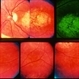 Macular Atrophy Macular Atrophy