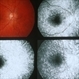 Multiple Evanescent White Dot Syndrome (MEWDS) Multiple Evanescent White Dot Syndrome (MEWDS)