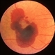 Exudative Age-Related Macular Degeneration Exudative Age-Related Macular Degeneration