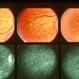 Multiple Evanescent White Dot Syndrome (MEWDS) Multiple Evanescent White Dot Syndrome (MEWDS)