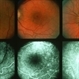 Multiple Evanescent White Dot Syndrome (MEWDS) Multiple Evanescent White Dot Syndrome (MEWDS)