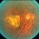 End Stage Age-Related Macular Degeneration End Stage Age-Related Macular Degeneration