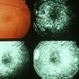 Multiple Evanescent White Dot Syndrome (MEWDS) Multiple Evanescent White Dot Syndrome (MEWDS)