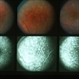 Multiple Evanescent White Dot Syndrome (MEWDS) Multiple Evanescent White Dot Syndrome (MEWDS)