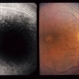 Adult Vitelliform Dystrophy