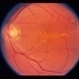 Pattern Dystrophy