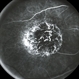 Macular Staphyloma Macular Staphyloma