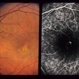 Adult Vitelliform Dystrophy