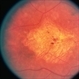 Macular Atrophy Macular Atrophy