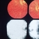 Inflammation Inflammation