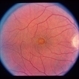 Adult Vitelliform Dystrophy