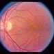 Adult Vitelliform Dystrophy